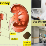 Use Ultrasound or CT Scan for Kidney Stone